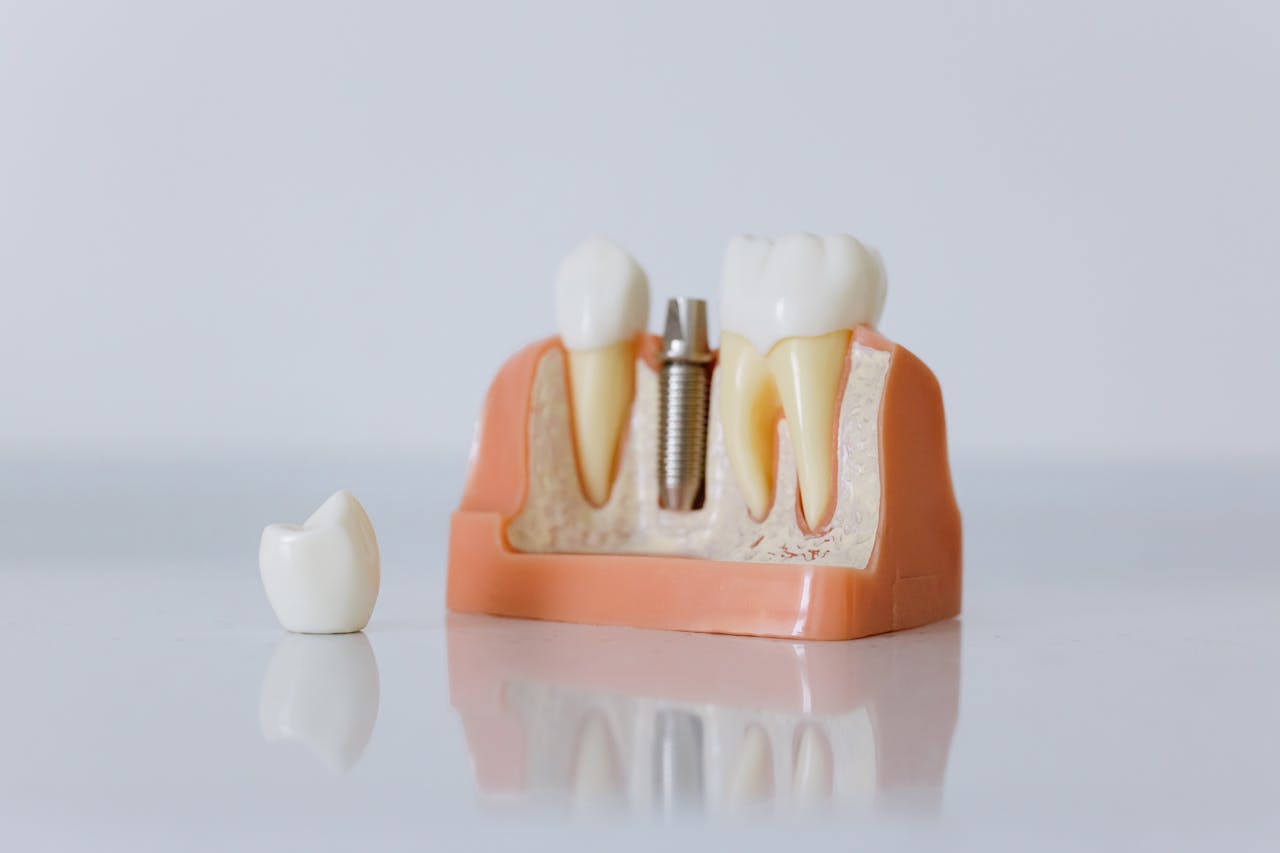 heros-img Close-up of a dental implant model featuring artificial teeth and jaw structure.